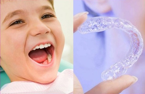 điều trị chỉnh nha bằng khay Smartee