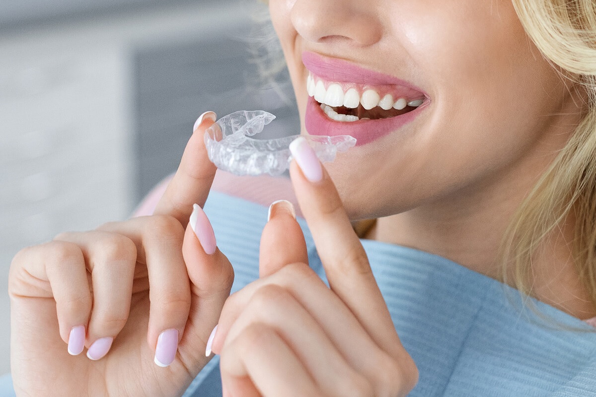 Sử dụng niềng răng trong suốt cho người trưởng thành